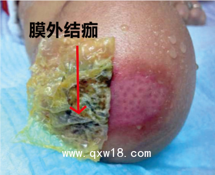 美國進(jìn)口歐密得Omiderm人工皮膜 傷口敷料